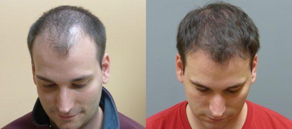 Hair Restoration Savannah