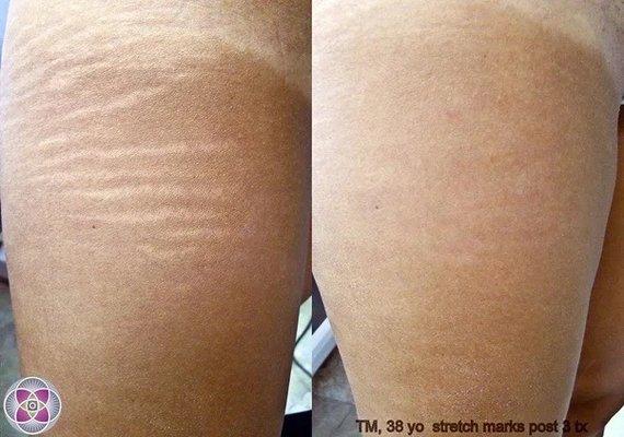 Scar before & after