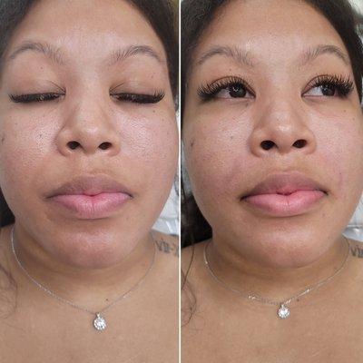 Minimize nasolabial folds with 1cc of Juvederm Vollure