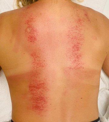 Gua Sha Scraping of Back