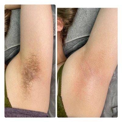 Underarm Sugaring  love serving first time clients  who get to see the benefits of beautiful Smith skin