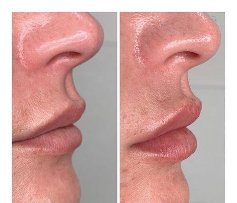 Lip Filler using Juvederm Ultra XC