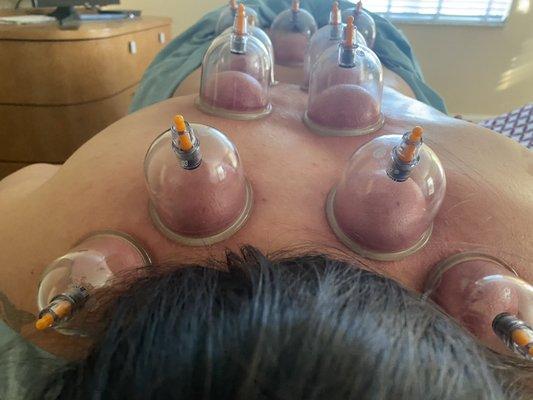 Cupping therapy