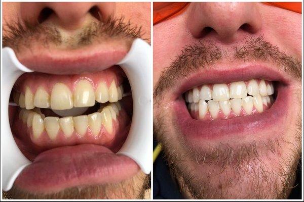 See Jonathan's Before & After with the help of GLO Teeth Whitening! He's extremely happy with the results and can't stop smiling!