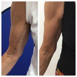 Before & After Profound treatment on the arms