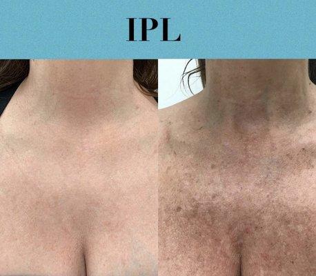 IPL remove sun damage and gives you that youthful look again