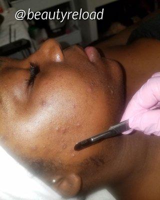 Dermaplaning!