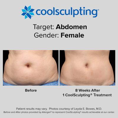 Before and After photos provided by Allergan® to represent results achievable with CoolSculpting.