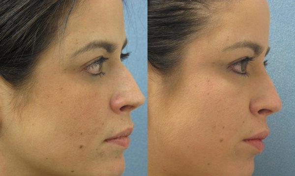 Before and after of non-surgical nose correction with fillers.