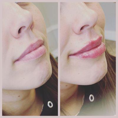 Gorgeous lips filled with 1/2 syringe of dermal filler