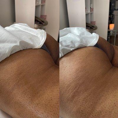 Before after wood therapy butt lift one session