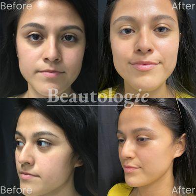 Lip Fillers 1cc Restylane Before and After