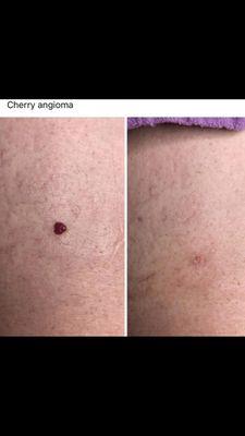 Cherry angiomas removed