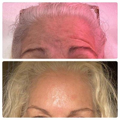 Botox before and after