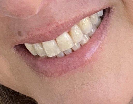 Before whitening