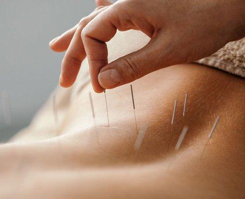 Lower back acupuncture needle treatment can reduce pain