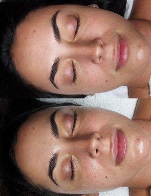 Dermaplaning facials help remove your facial hair and leave your skin feeling soft and smooth.