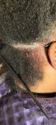 Scalp Treatments