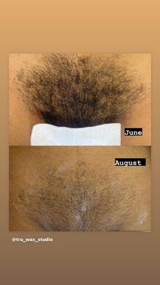 Regrowth... results of waxing consistently