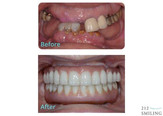 Before and After Teeth in a Day Surgery - https://www.212smiling.com/dental-implants-new-york-city/teeth-in-an-hour/