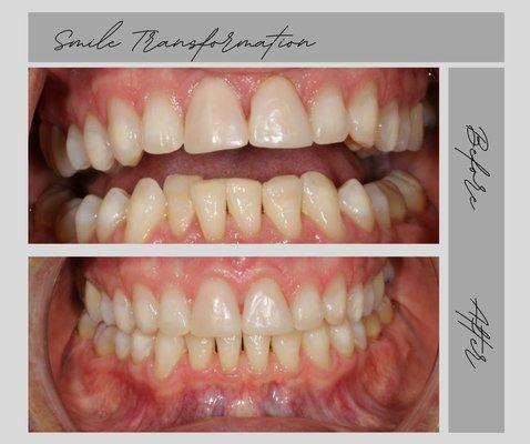 Sure Smile clear orthodontic aligners- A faster more comfortable way to achieve teeth movement Great Results that are designed to last!