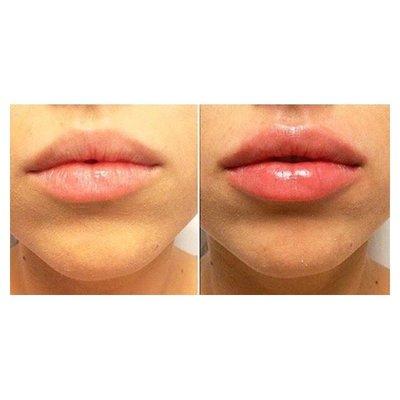 Juvederm on lips