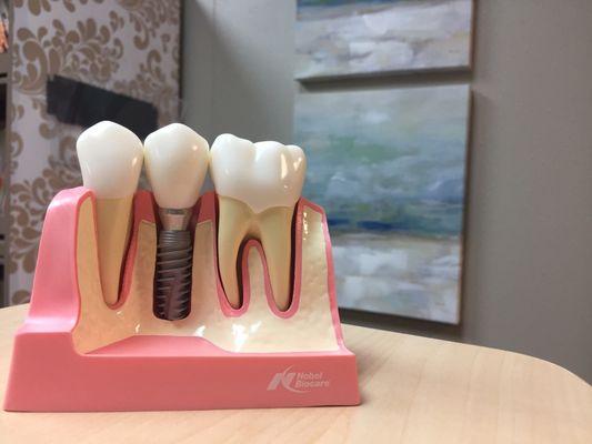 Dental implant model