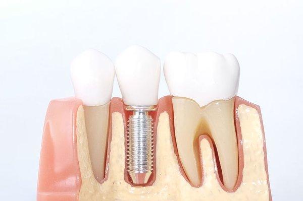 Dental implants.  We place them.