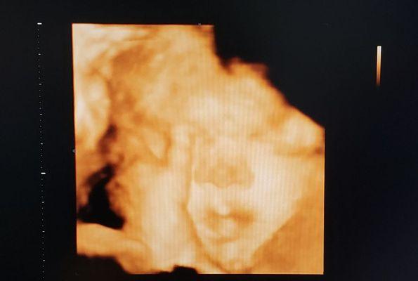 3d Ultrasound Image