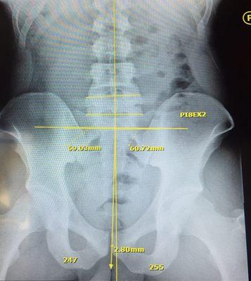 Your pelvis should be level much like the foundation of a building. An imbalance can lead to early degenerative changes of the spine.