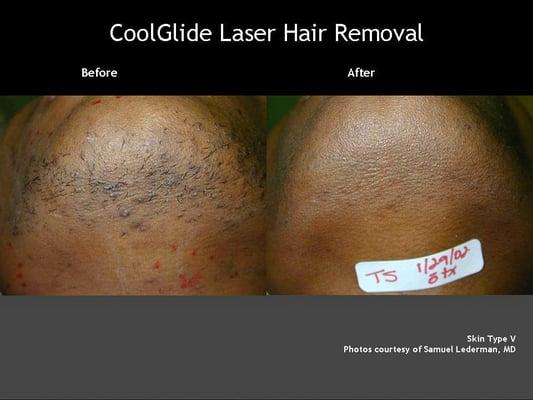 Laser Hair Removal-Chin