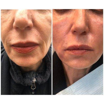 Dermal Fillers, Sculptra, Botox and more