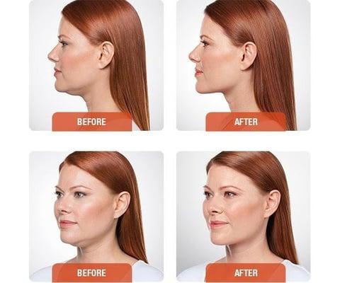 Introducing Kybella for Submental Fullness (double chin).  Call to schedule your free consultation today!