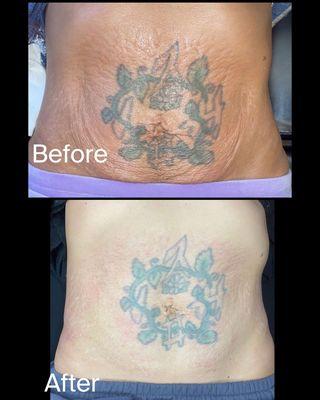 Fibroblast before and after 5 treatments