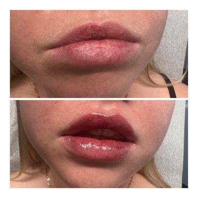 Discover the art of balance! Lip fillers can work wonders in harmonizing asymmetrical lips, helping you achieve that perfect pout.