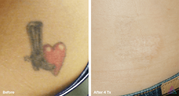 Removed after 4 Laser Tattoo Removal Treatments