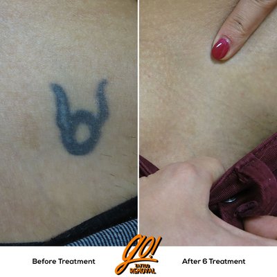 Hip tattoo removed in 6 treatments