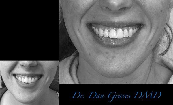 Braces: Smile with Confidence!