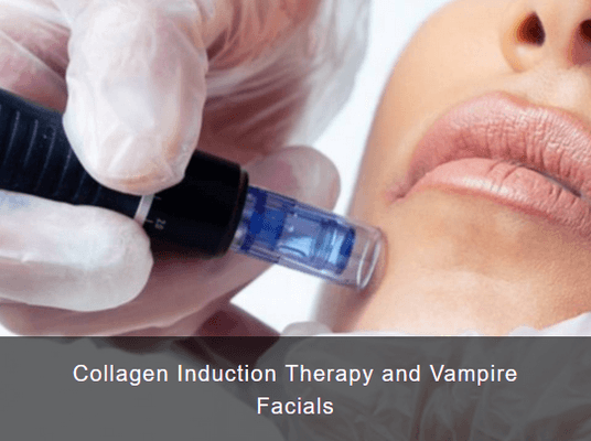 Collagen Induction Therapy and Vampire Facials