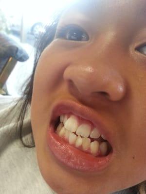 Omg! Jenna needs braces! My insurance doesn't cover:( boo I told her daddy, says he cannot afford it?? My son perfect teeth!