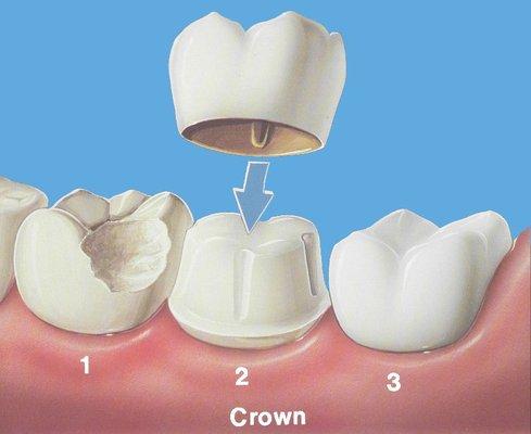 Teeth that are significantly damaged by decay or trauma sometimes require a crown rather than a filling.