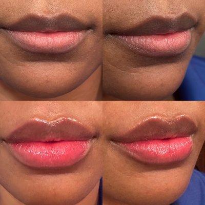 Lip filler by Breyonna. 1 mL Restylane Defyne