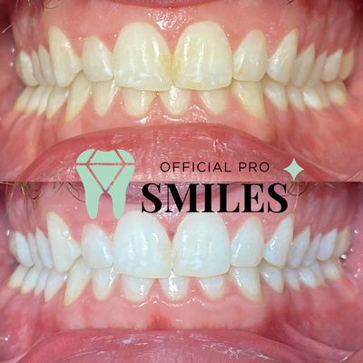 Teeth whitening chandler Arizona. www.Officialprosmiles.com