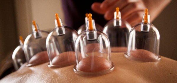 Myofascial Cupping