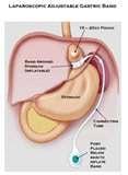 Lap Band Surgery
