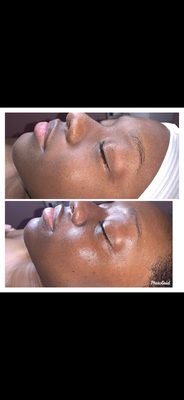 Before and after facial treatment