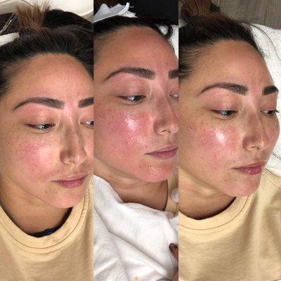 Signature Peel with Corinne