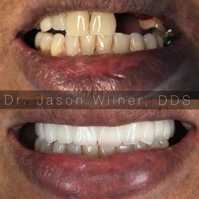 Smile in a day makeover with dental implants --