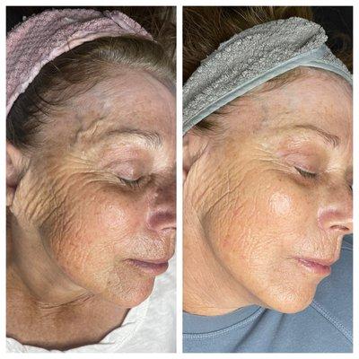 Anti aging facial