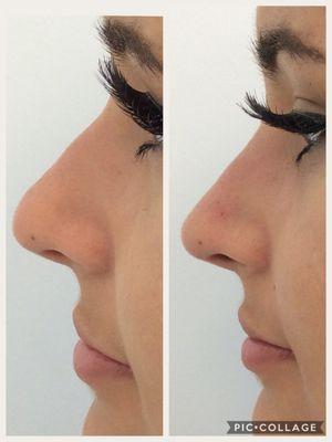 Non surgical rhinoplasty